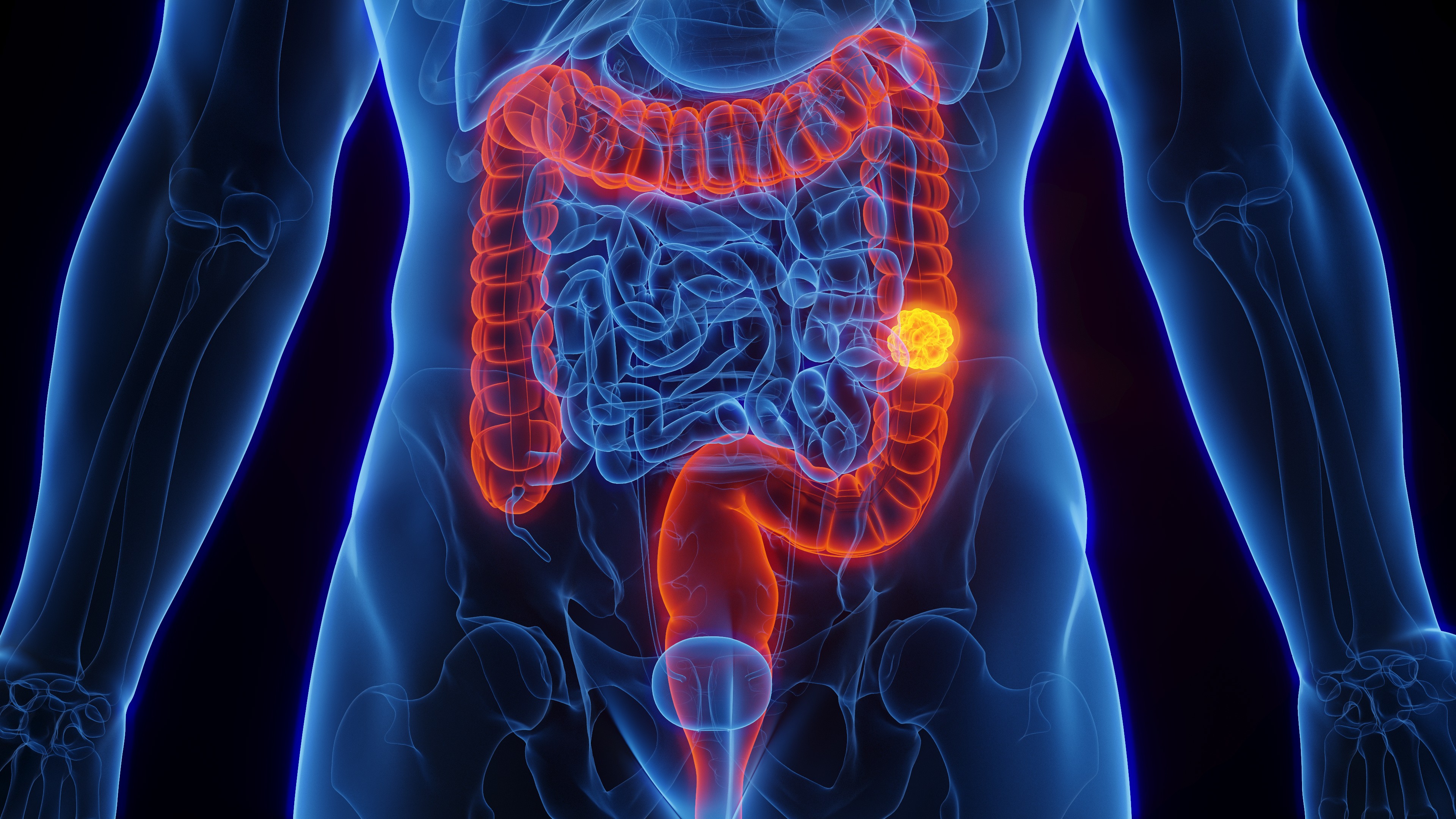 SUS adota novo exame para detectar câncer de intestino antes dos sintomas