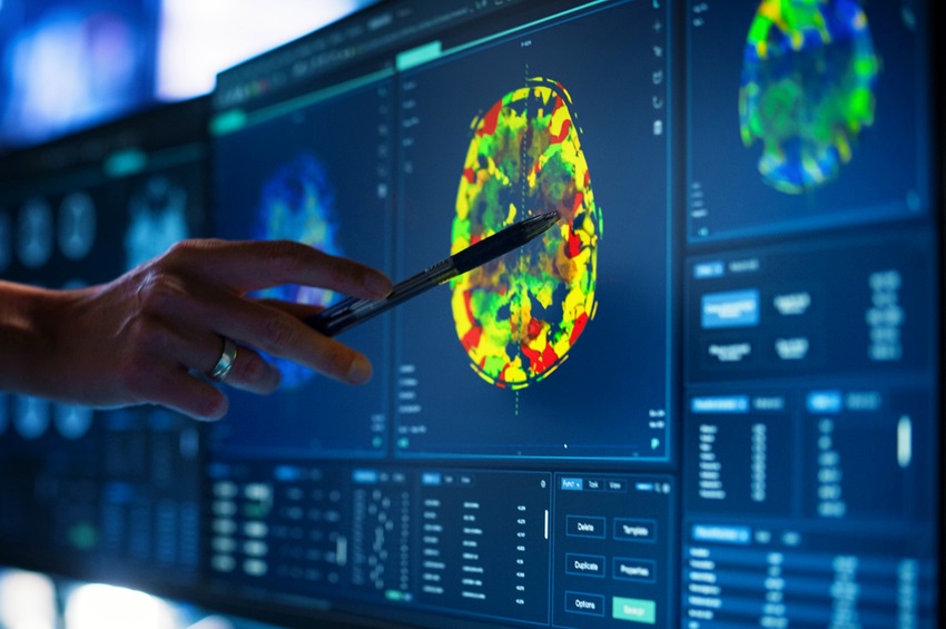 Estudo aponta mudanças décadas antes dos sintomas do Alzheimer