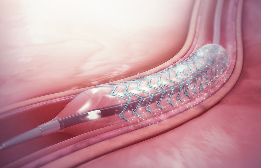 Maior estudo do mundo com stents em diabéticos reafirma eficácia do tratamento padrão atual