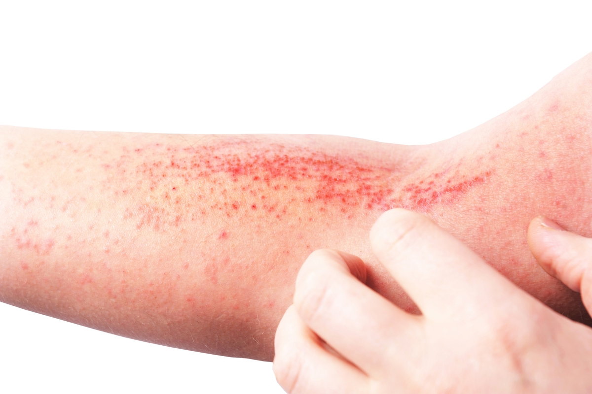 Por onde sai sangue na dengue hemorrágica?