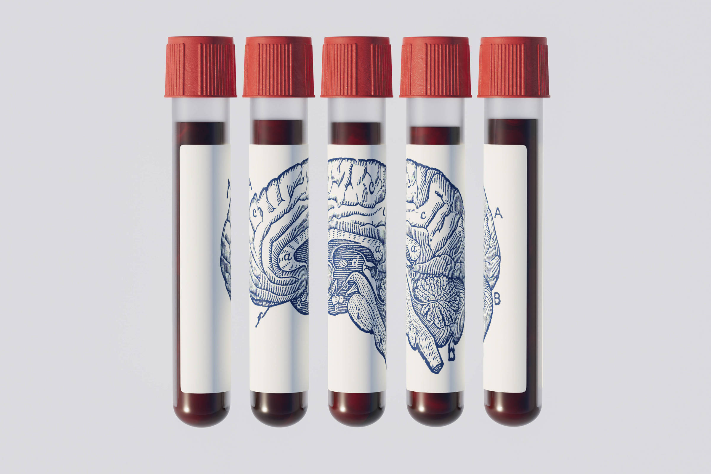 Exame de sangue promete prever Alzheimer anos antes; entenda por que médicos pedem cautela